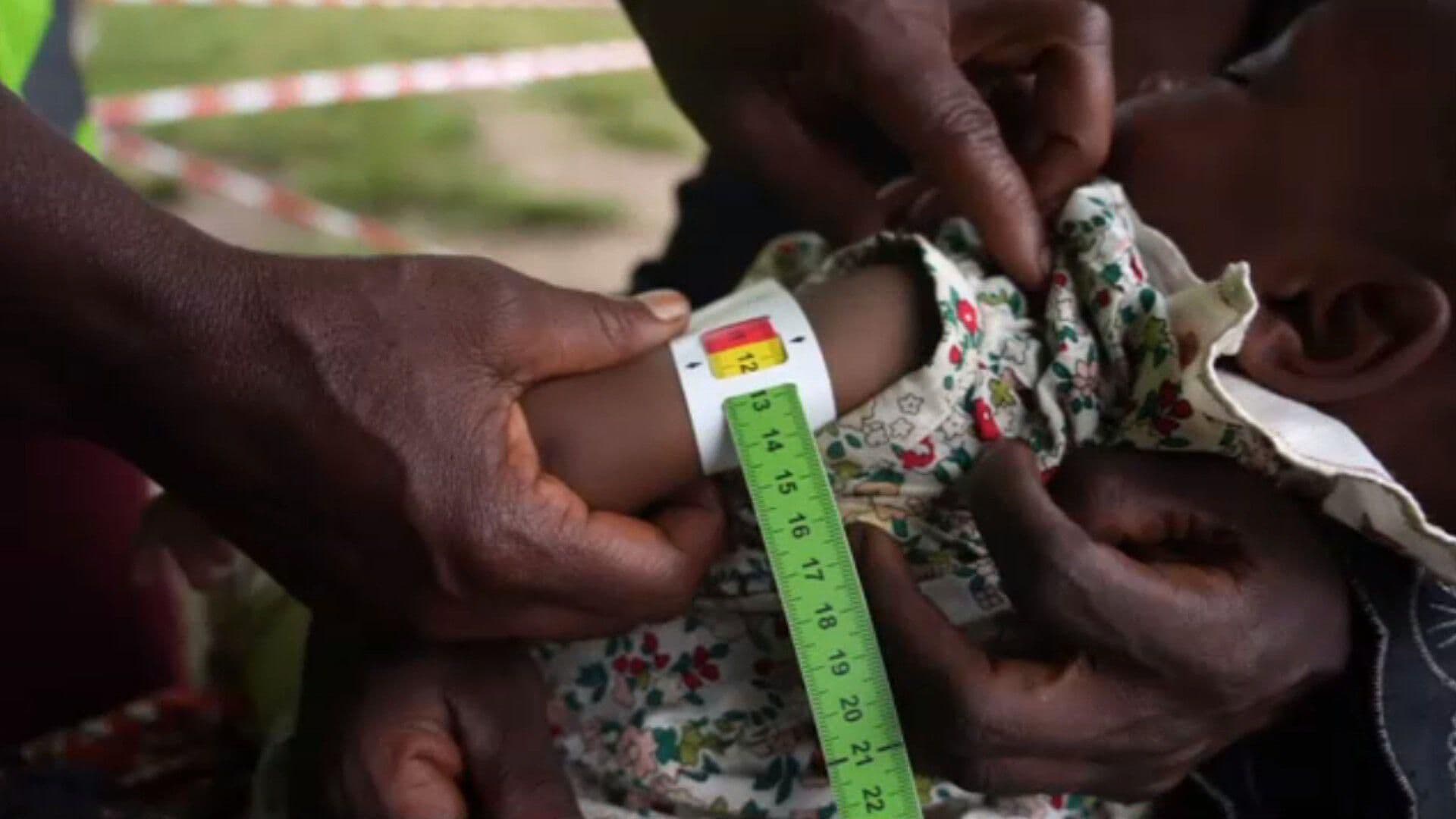 Emergencia en Congo: Desnutrición Masiva Devasta a Millones en Crisis Alimentaria