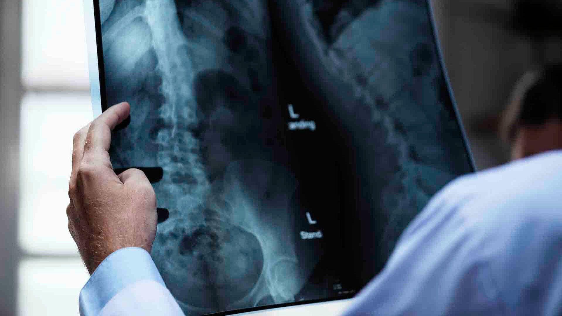 Escoliosis Idiopática: Desafío en Niños y Adolescentes