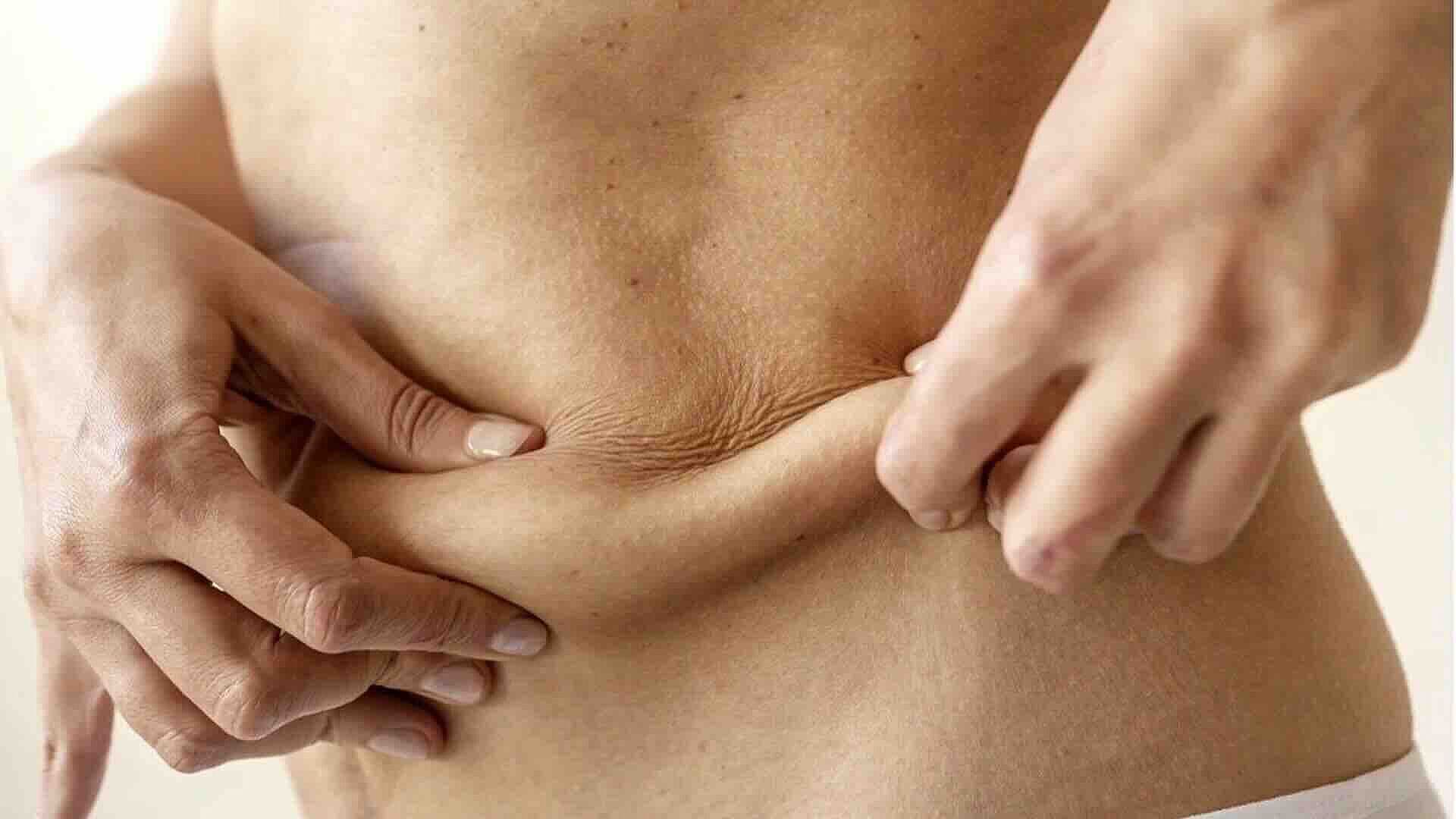 ¿Qué Riesgos Tiene una Liposucción Mal Hecha? Especialista lo Explica