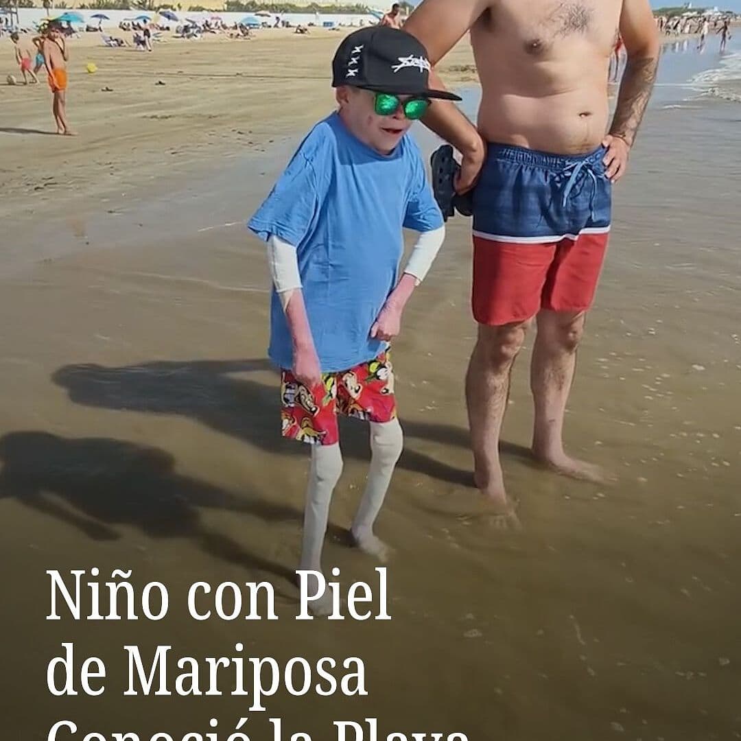 Niño con Piel de Mariposa Conoció la Playa