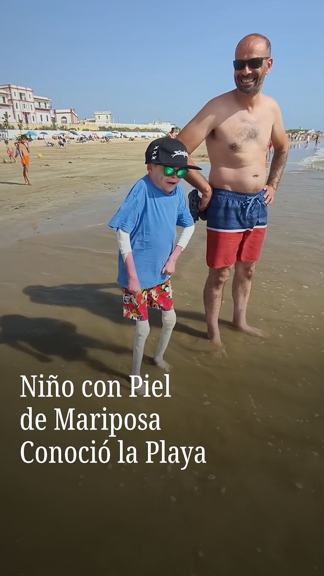 Niño con Piel de Mariposa Conoció la Playa
