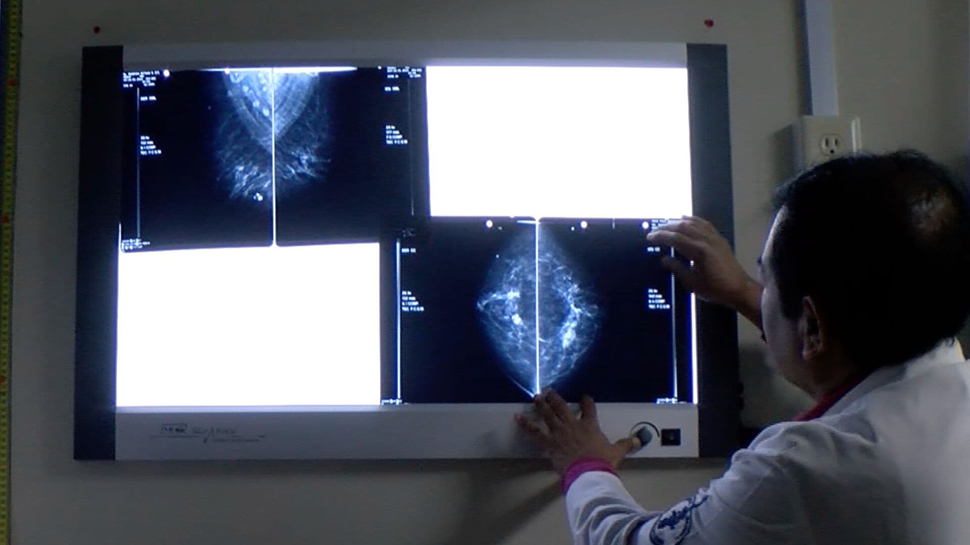 Incrementan los Índices de Mujeres con Cáncer de Mama en Veracruz