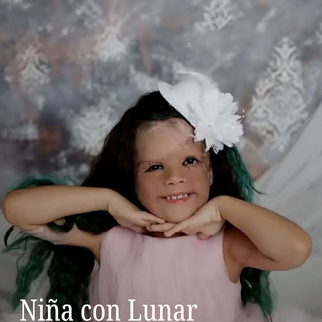 Niña con Lunar en Rostro Completa Tratamiento