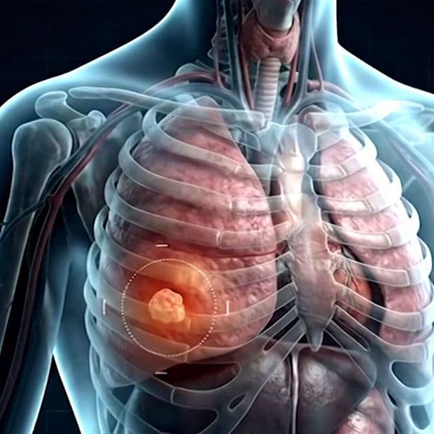 Cáncer de Pulmón del Papa León XIV Pone el Foco en el Adenocarcinoma