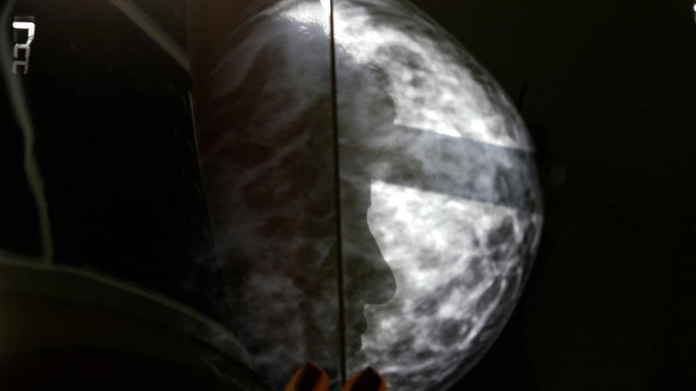 Lucha Contra el Cáncer de Mama: Síntomas de Alerta y Autoexploración