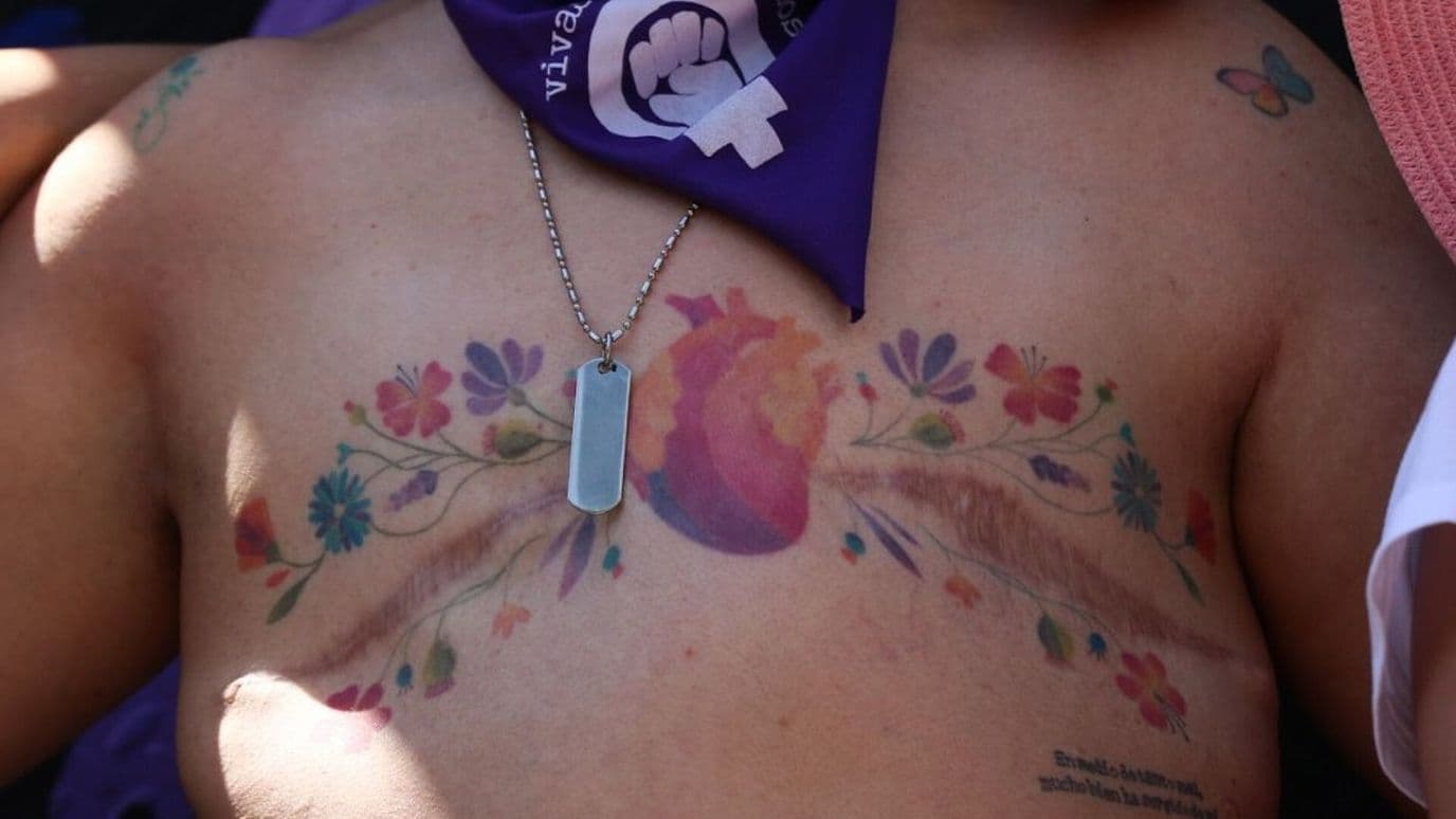Mastectomía: Una Nueva Esperanza en la Lucha contra el Cáncer de Mama