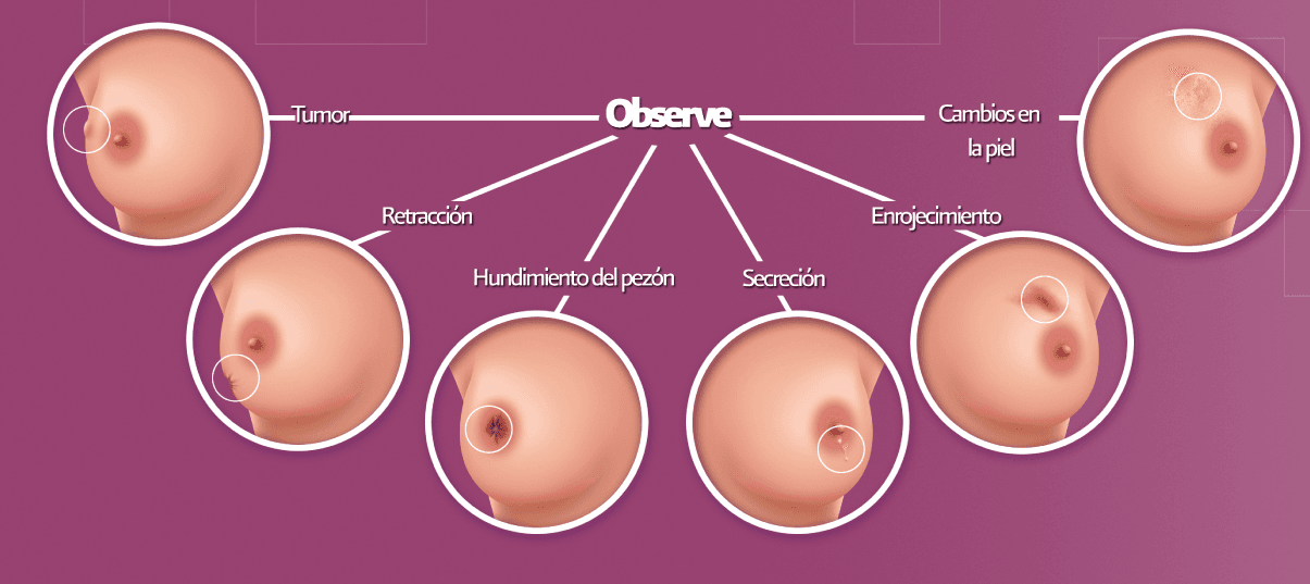 Expoloración de las mamas