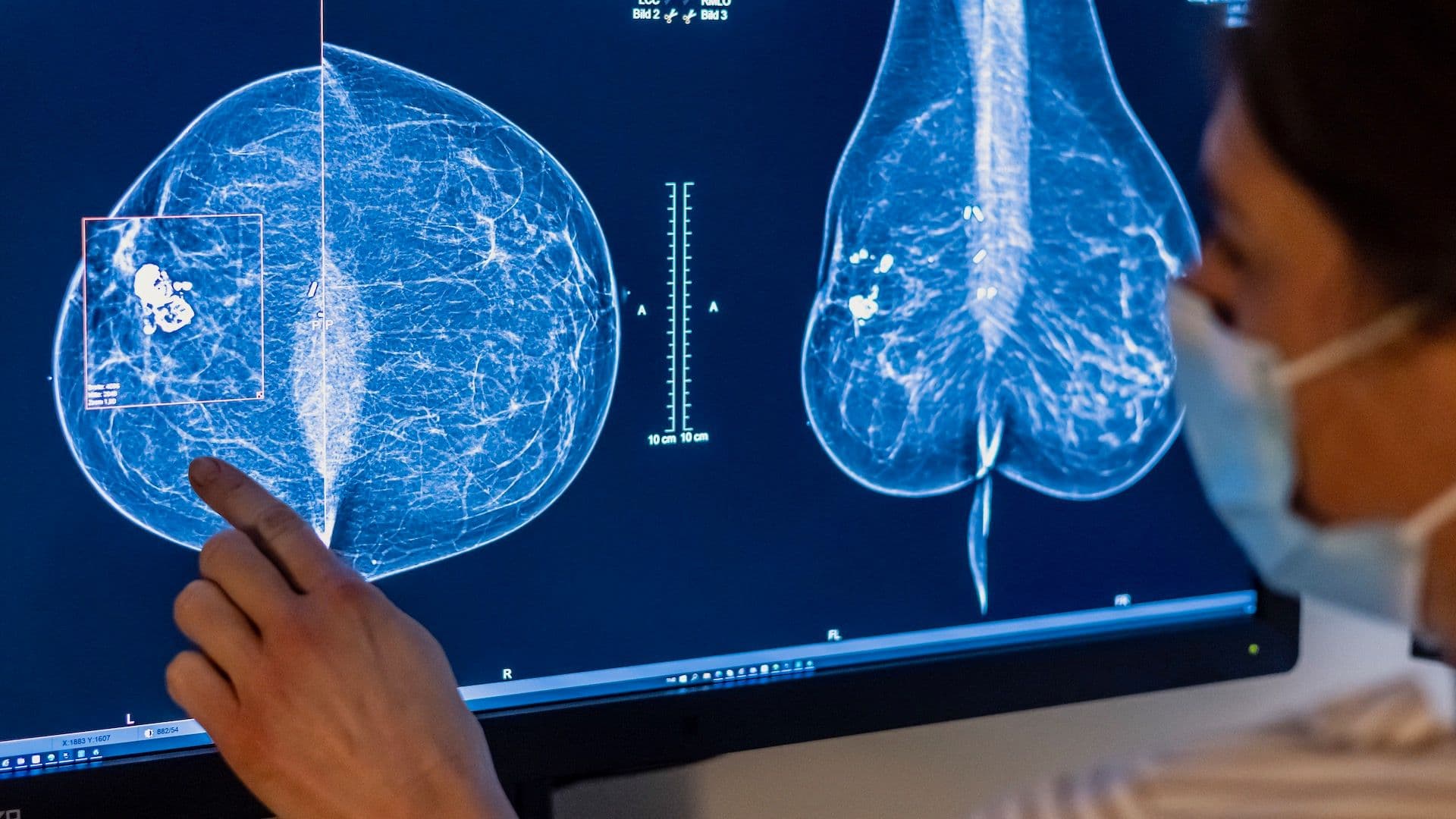 Crean Prueba Que Evitaría la Quimioterapia para Millones de Pacientes con Cáncer de Mama