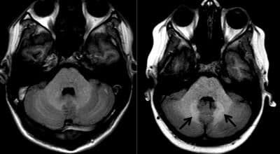 Imágenes de RM cerebral: las flechas indican áreas de mayor actividad de señal (derecha) en comparación con el control normal (izquierda).