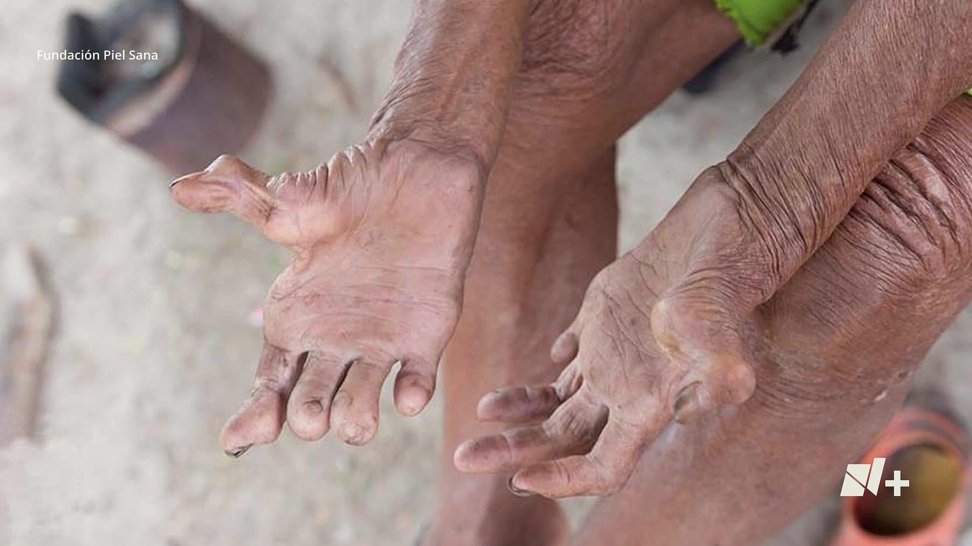 Secretaría de Salud Confirma Cuatro Casos de Lepra en Jamapa