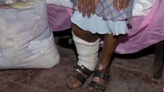 Hermanos Adultos Mayores con Síntomas de Lepra en Jamapa