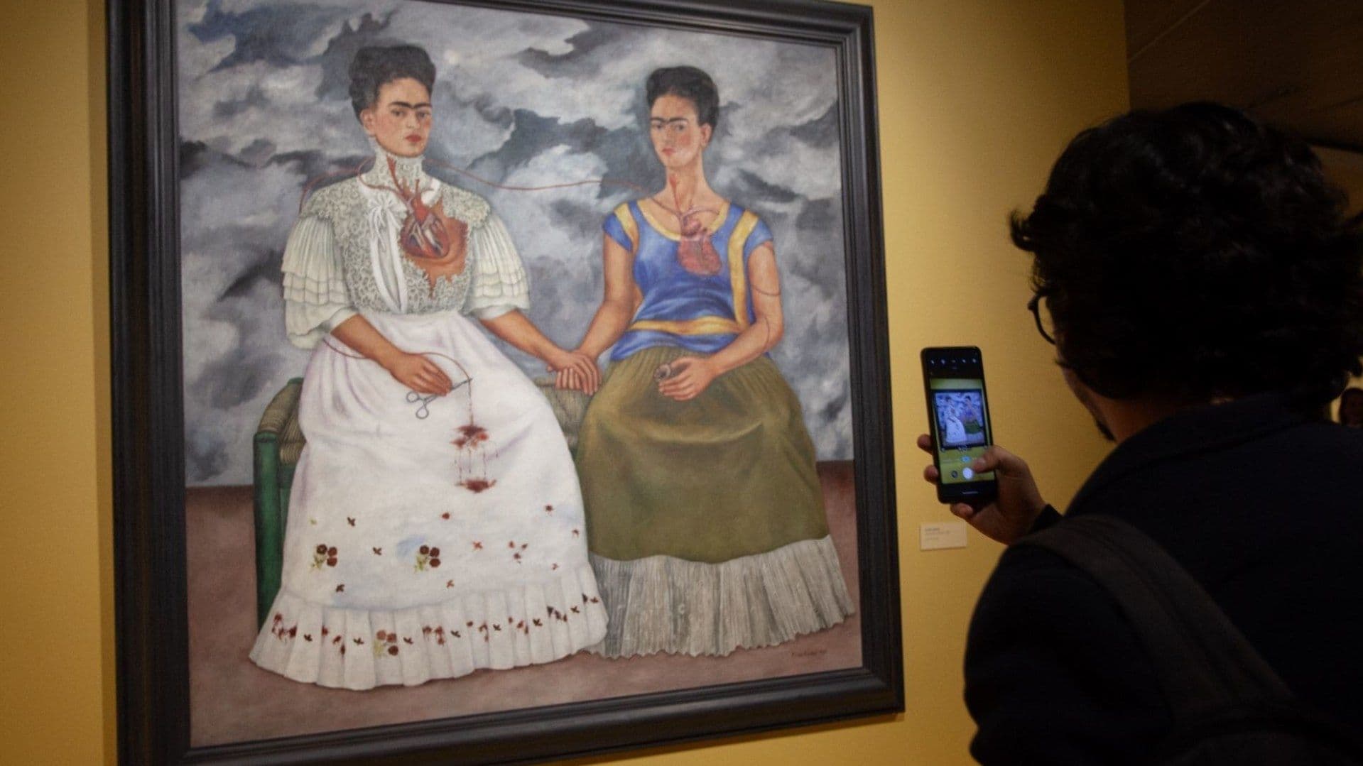 Frida Kahlo Padecía Síndrome de Cola de Caballo, Revela Estudio