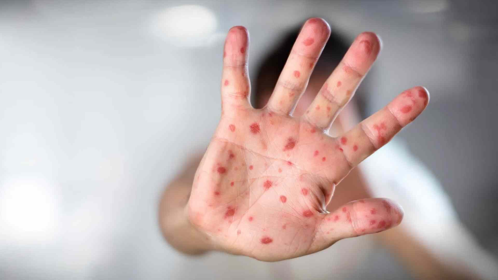 Arribo de Niña Mexicana Con Sarampión a Costa Rica Activa Protocolo de Vacunación