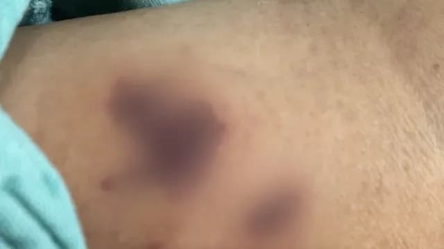 Familiares Denuncian que la Paciente se Infectó de una Bacteria