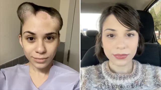 Alondra Sierra antes y después de su cirugía reconstructiva
