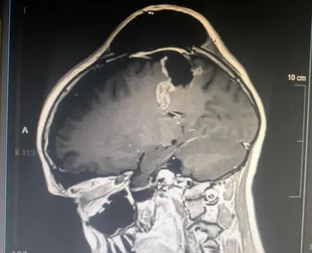 Le dijeron que usaba mucho el celular, pero lo que tenía era un tumor