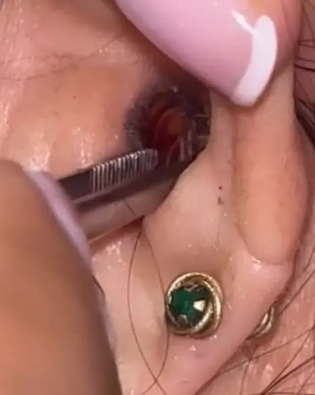 Va a Revisión Por Dolor de Oído y le Sacan una Cucaracha