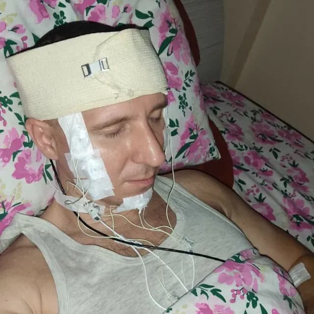 Michael Raduga: Hombre se perfora cráneo en Rusia
