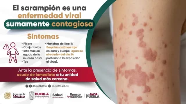 Salpullido característico del sarampión, comienza en rostro y sigue en el cuerpo. Foto: Salud Puebla