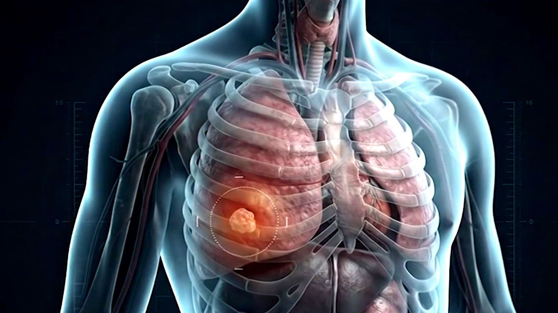 Cáncer de Pulmón del Papa León XIV Pone el Foco en el Adenocarcinoma