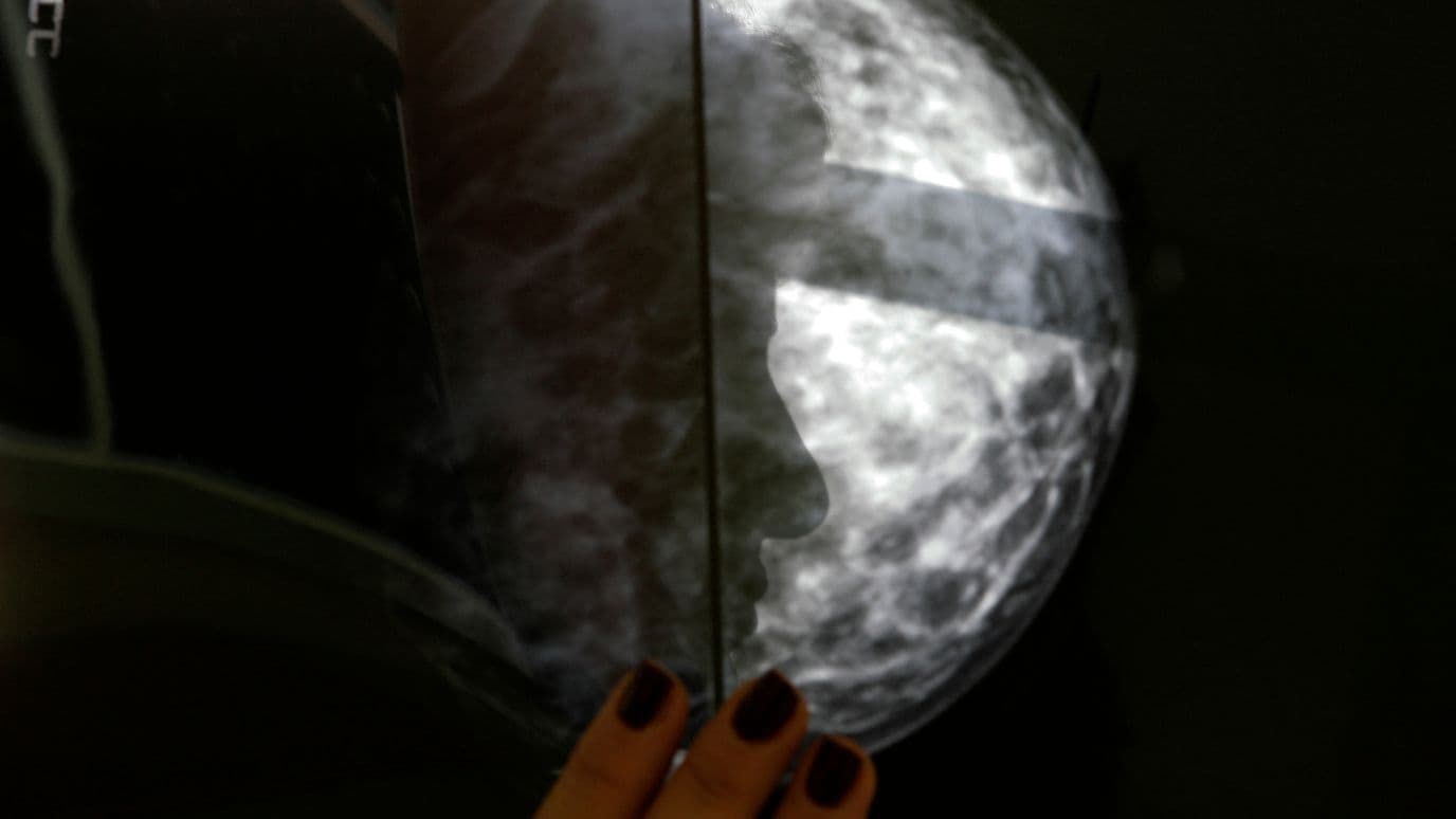 Desarrollan un Modelo de IA para Detectar Metástasis de Cáncer de Mama en la Axila