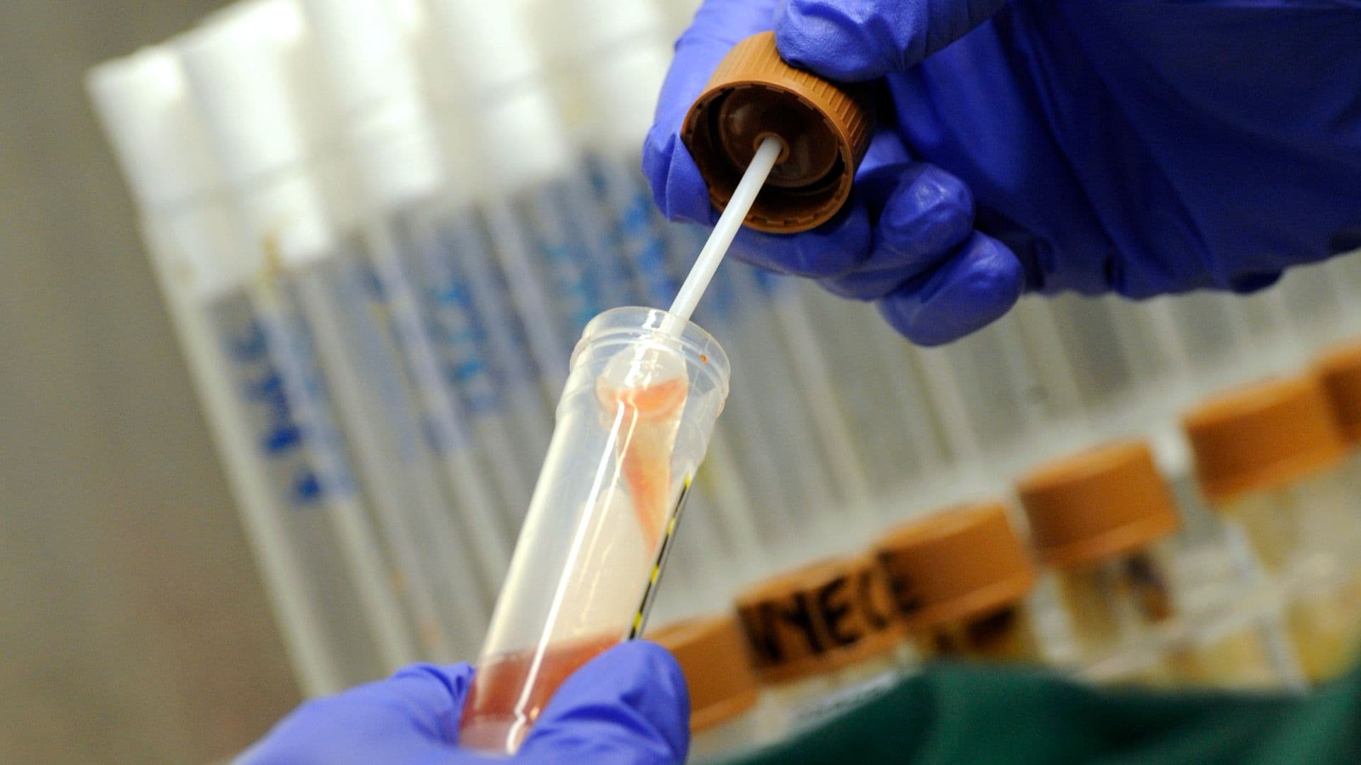 ¿Qué Es la Bacteria Come Carne? Reportan 1 Muerto y Varios Casos Confirmados