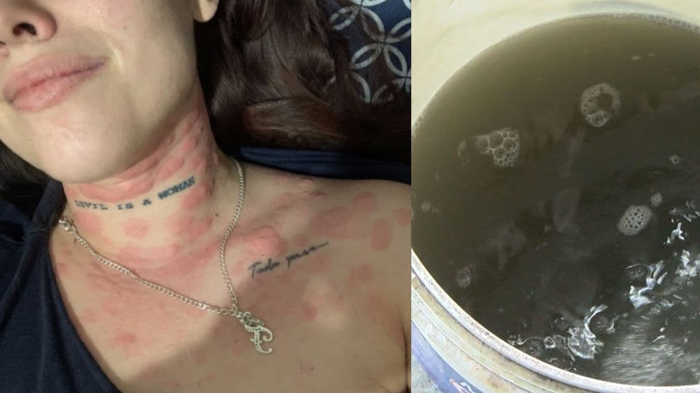 Vecinos de Guadalajara Denuncian Ronchas en la Piel por Agua Sucia